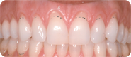 Before Periodontal Plastic Surgery at Martin Periodontics 