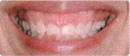 Before Periodontal Plastic Surgery at Martin Periodontics 