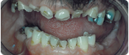 Before image of a dental implant candidate at Martin Periodontics in Mason & North Cincinnati, OH