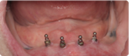 Before image of a dental implant candidate at Martin Periodontics in Mason & North Cincinnati, OH