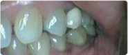 Before image of a dental implant candidate at Martin Periodontics in Mason & North Cincinnati, OH