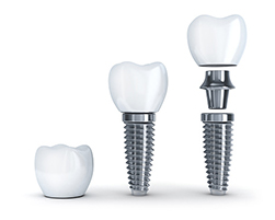 3D model of a dental implant provided at Martin Periodontics 