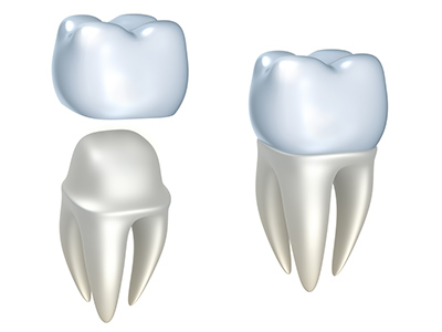Dental crown treatment at Martin Periodontics 