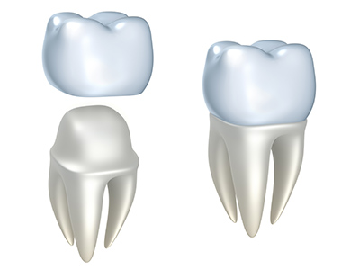 Dental crown treatment at Martin Periodontics in Mason, OH