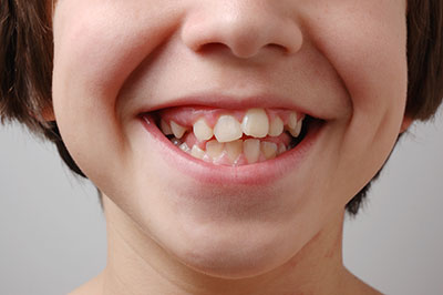 Close up of misaligned teeth caused by impacted teeth