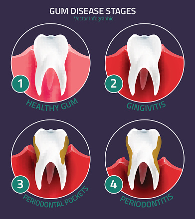 Image of gum disease, at Martin Periodontics.