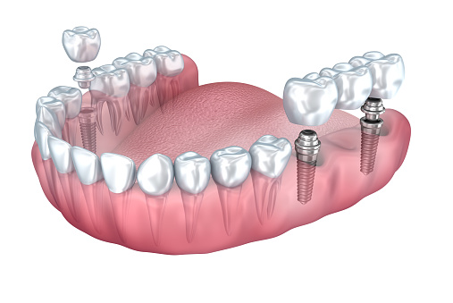 Dental implants at Martin Periodontics 