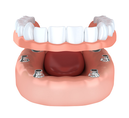 3D model of implant supported dentures being placed in the mouth