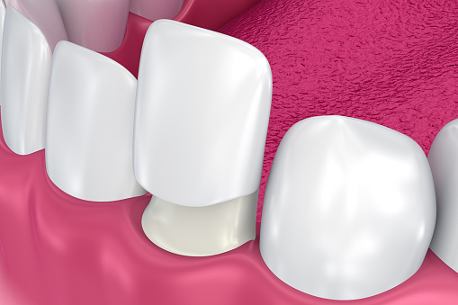 Porcelain Veneers at Martin Periodontics 