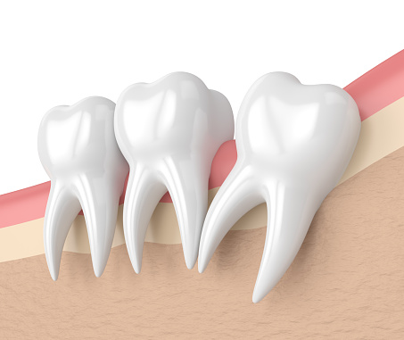 Distal wedge procedure at Martin Periodontics 