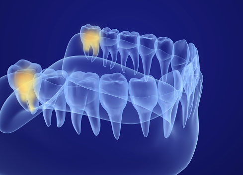 Wisdom teeth removal at Martin Periodontics in Mason & North Cincinnati, OH