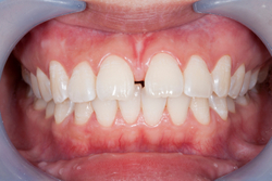 Frenectomy procedure at Martin Periodontics 