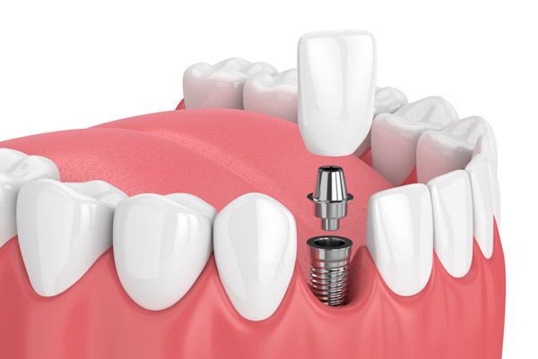 A rendering of a dental implant at Martin Periodontics in Mason, OH