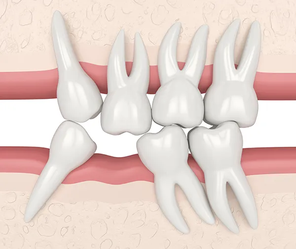 3D rendered cross-section view of seven misaligned and crooked teeth crowding the empty space where a missing tooth should be.