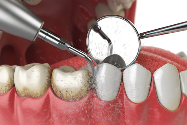 Diagram of teeth and gum cleaning at Martin Periodontics in Mason, OH 45040-7909