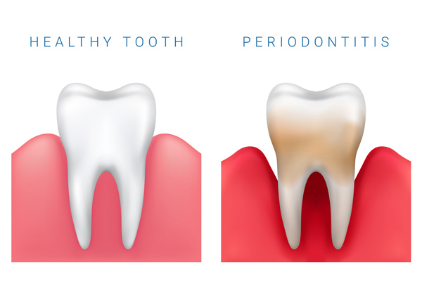 Photo of gum disease and healthy teeth at Martin Periodontics in Mason, OH