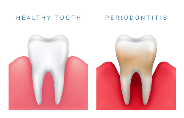 Treatment Options in Periodontics