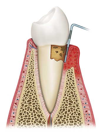 Scaling and Root Planing Gum Disease treatment at Martin Periodontics 