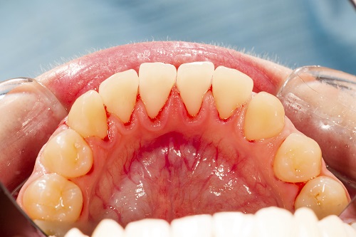 What is Periodontal Disease?