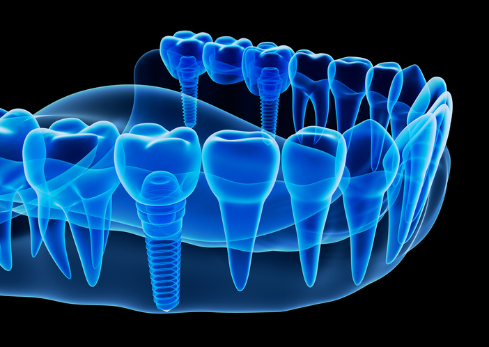 Replacing multiple teeth with dental implantsMartin Periodontics 