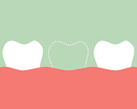 Rendering of a mouth with missing teeth in need of socket grafting at Martin Periodontics in Mason, OH